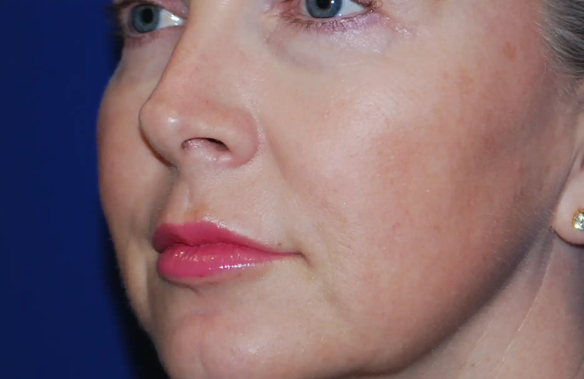 ansikt etter å ha brukt barrier pro serum spray i 4 uker