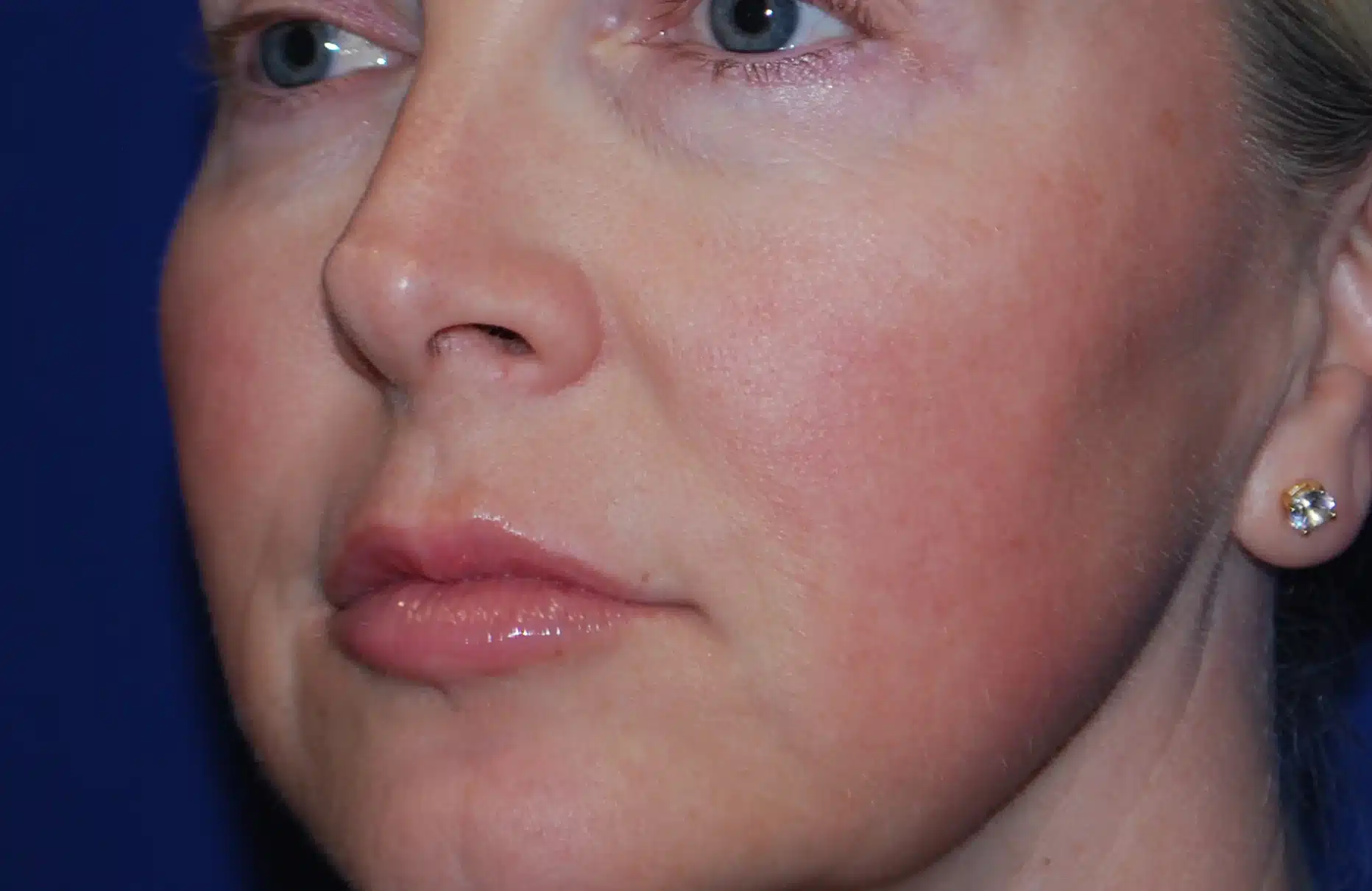 ansikt før bruk av barrier pro serum spray